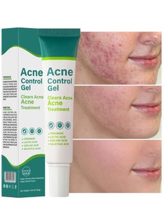 Buy Acne Treatment Cream,Acne Spot Treatment gel,Clear Acne Spot Treatment Gel,Pimple Cream for Acne Prone Skin Care,Acne Control Gel,Salicylic Acid Acne Treatment Gel,Clear Breakouts, 30g in Saudi Arabia