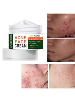 اشتري Acne Treatment Face Cream, Acne Spot Treatment for Face & Acne Dots, Natural Cystic Acne Treatment, For All Skin Types, Premium Acne Scar Cream & Pimple Remover - 30ML في السعودية