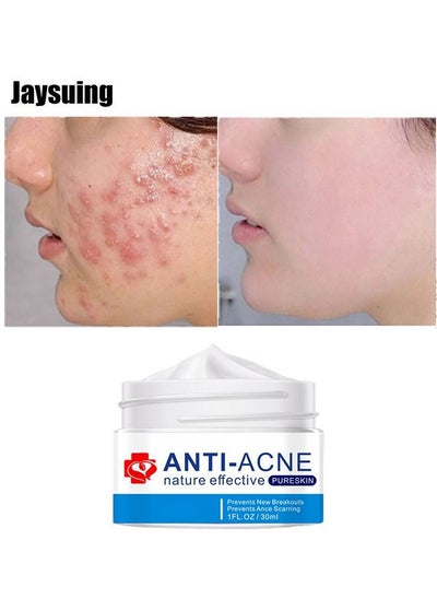 Buy Acne Treatment Face Cream, Acne Spot Treatment for Face and Acne Dots, Natural Cystic Acne Treatment, For All Skin Types, Premium Acne Scar Cream and Pimple Remover, 30ML in Saudi Arabia