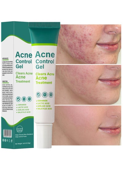 Buy Acne Treatment Cream,Acne Spot Treatment gel,Clear Acne Spot Treatment Gel,Pimple Cream for Acne Prone Skin Care,Acne Control Gel,Salicylic Acid Acne Treatment Gel,Clear Breakouts, 30g in Saudi Arabia