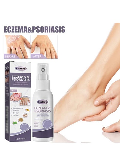 Buy Eczema and Psoriasis Non-Steroidal 100% Natural Relief，Atomizing Spray 30ml, Hand and Foot Moss Skin Repair, Relieve Itching, Skin care and Jiejia spray, Antibacterialnot Irritating Safety in UAE