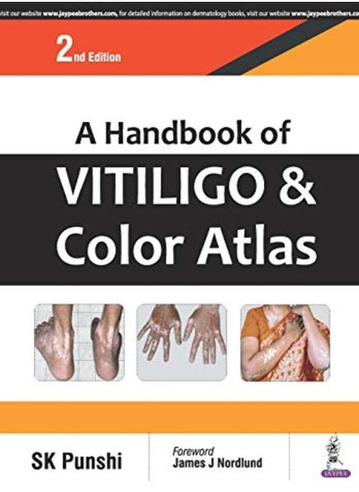 Buy A Handbook Of Vitiligo & Color Atlas by Punshi, S. K. Paperback in UAE