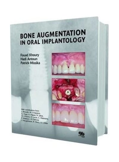 Buy Bone Augmentation In Oral Implantology hardcover english in UAE